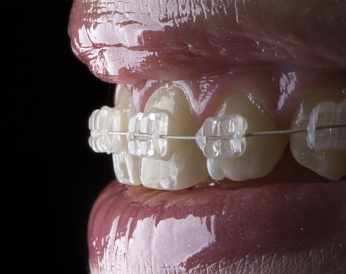 Ceramic Braces | Striaghten Teeth | Vilafortuny Clinic