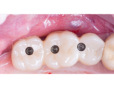 https://vilafortuny.com/wp-content/uploads/2022/12/dental-implant-adental-implants-after-dr.alain-romanos-dubai-vilafortuny.jpg