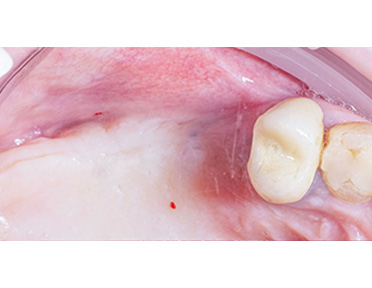 https://vilafortuny.com/wp-content/uploads/2022/12/dental-implants-before-dr.alain-romanos-dubai-vilafortuny.jpg