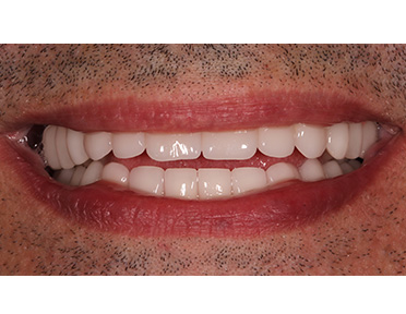https://vilafortuny.com/wp-content/uploads/2022/12/replacement-of-missing-teeth-implant-after-dubai-vilafortuny.jpg
