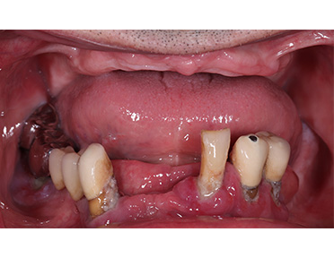 https://vilafortuny.com/wp-content/uploads/2022/12/replacement-of-missing-teeth-implant-before-dubai-vilafortuny.jpg