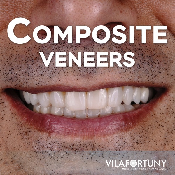 Transform Your Smile with Composite Veneers