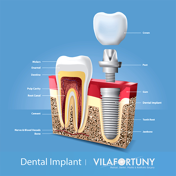 The Intelligent Choice: Dental Implants for a Renewed Smile at Vilafortuny Dubai
