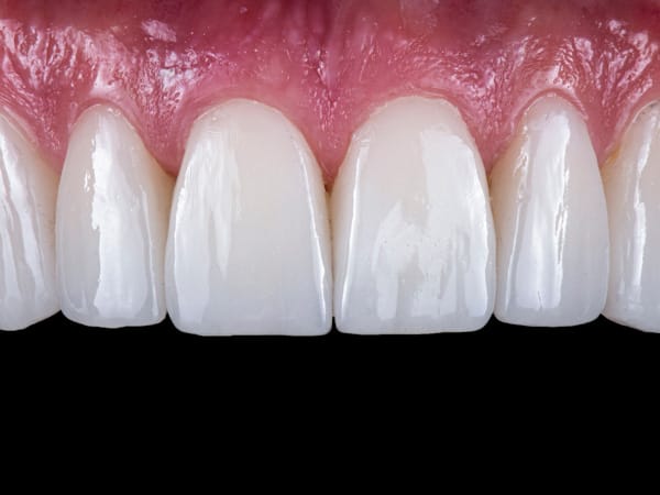 Zirconia Crown Result 1