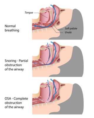 /wp-content/uploads/2026/02/obstructive-sleep-apnea-320x400.jpg